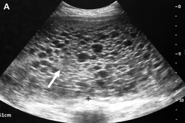 ultrazvuk- trudnoca