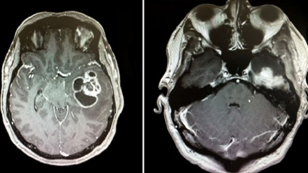 tumor-mozak