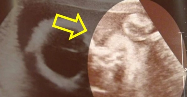 ultrazvuk-beba